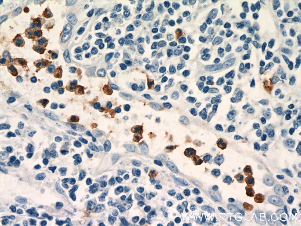 IHC staining of human tonsillitis using 15551-1-AP