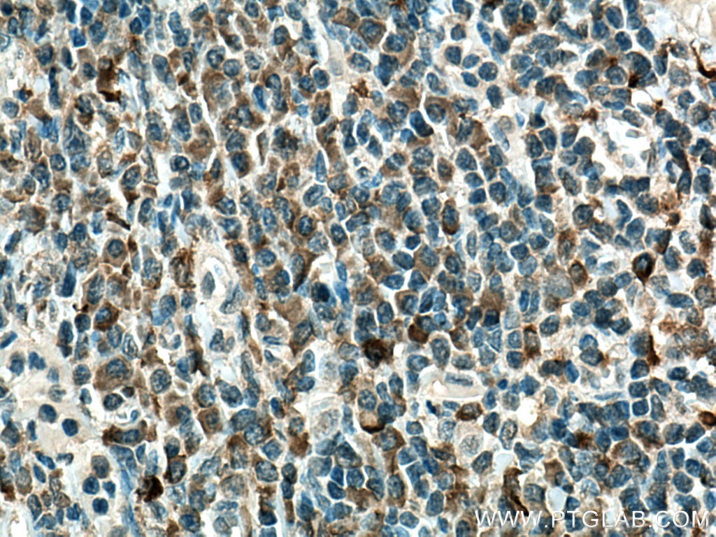 Immunohistochemistry (IHC) staining of human tonsillitis tissue using NOXA2/p67phox Monoclonal antibody (67594-1-Ig)