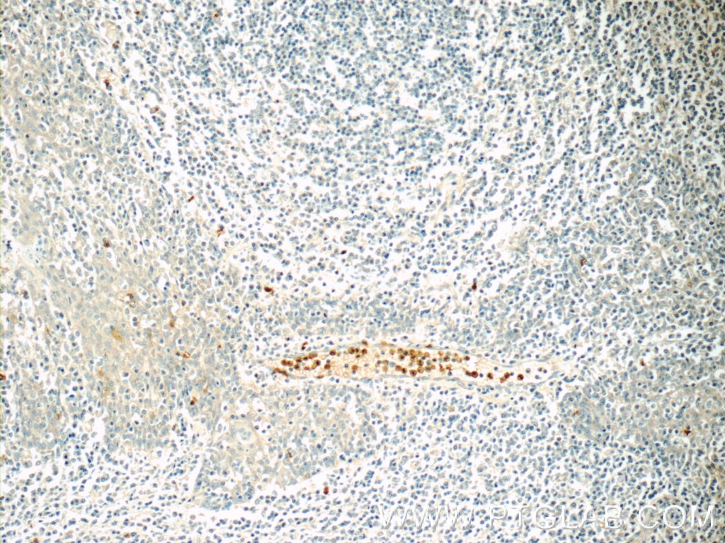 Immunohistochemistry (IHC) staining of human tonsillitis tissue using NCF4 Polyclonal antibody (15001-1-AP)