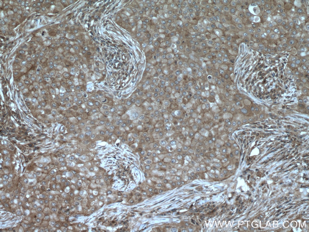 Immunohistochemistry (IHC) staining of human breast cancer tissue using NCK1 Polyclonal antibody (15247-1-AP)