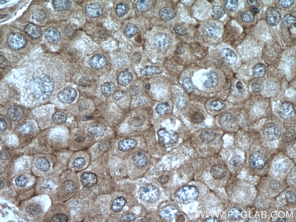 Immunohistochemistry (IHC) staining of human breast cancer tissue using NCK1 Polyclonal antibody (15247-1-AP)