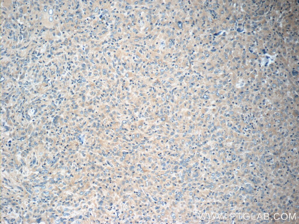 Immunohistochemistry (IHC) staining of human gliomas tissue using NCKAP1 Polyclonal antibody (12140-1-AP)