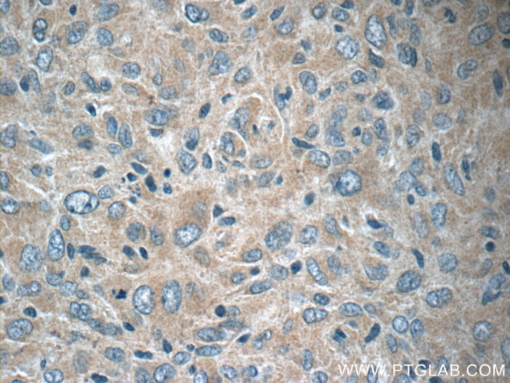 Immunohistochemistry (IHC) staining of human gliomas tissue using NCKAP1 Polyclonal antibody (12140-1-AP)