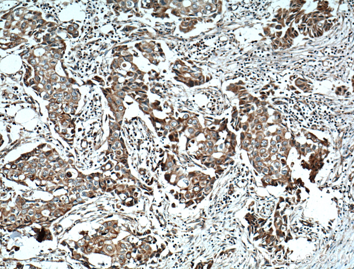 Immunohistochemistry (IHC) staining of human breast cancer tissue using NCKIPSD Polyclonal antibody (11367-1-AP)