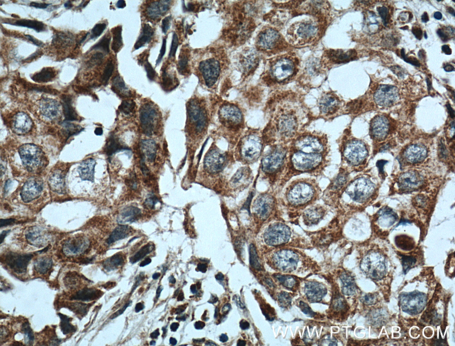 Immunohistochemistry (IHC) staining of human breast cancer tissue using NCKIPSD Polyclonal antibody (11367-1-AP)