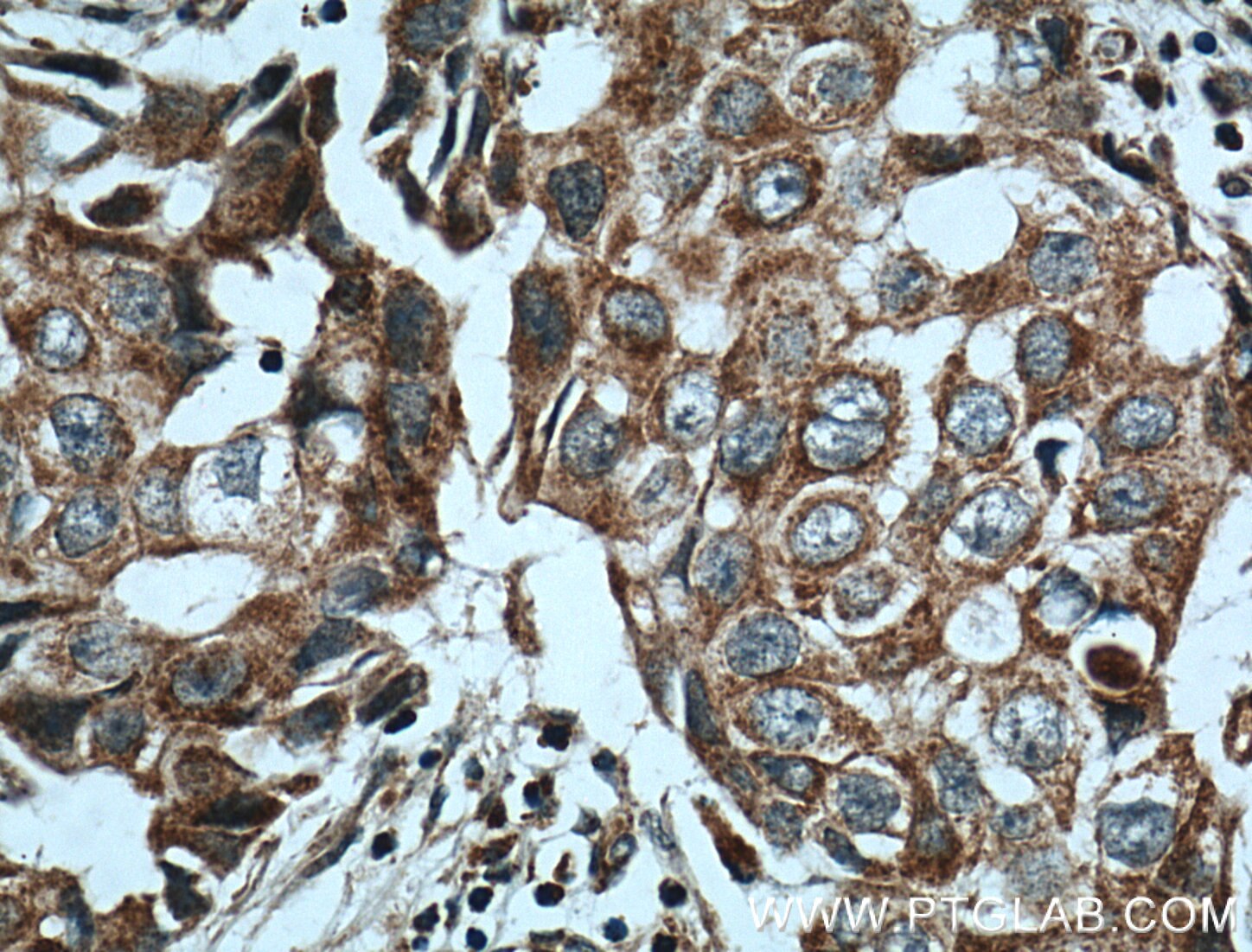 IHC staining of human breast cancer using 11367-1-AP