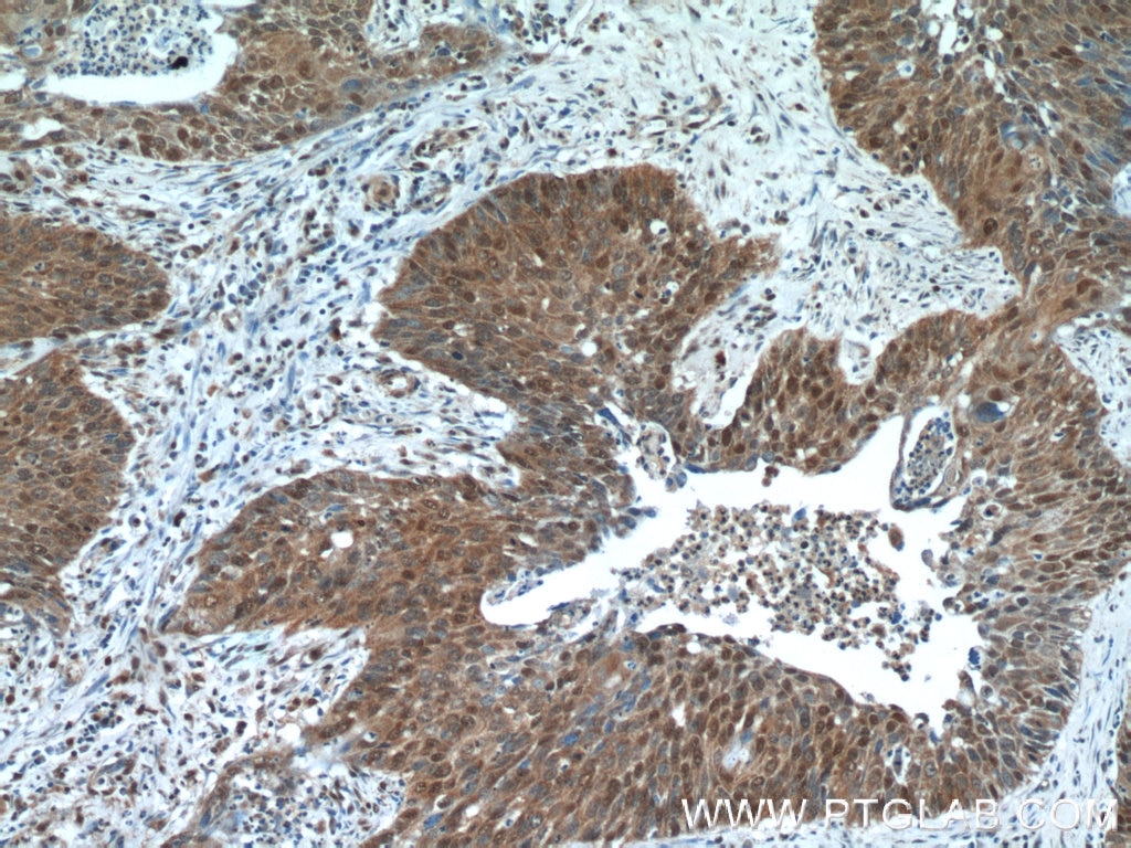 Immunohistochemistry (IHC) staining of human cervical cancer tissue using NCL Polyclonal antibody (10556-1-AP)