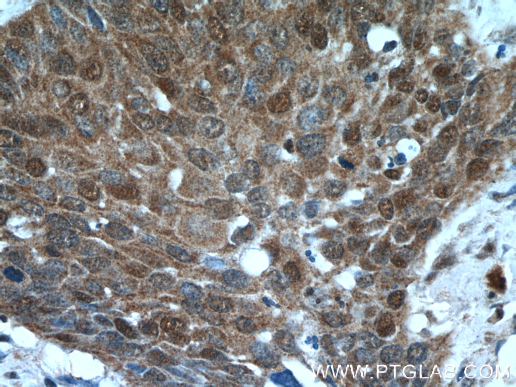 Immunohistochemistry (IHC) staining of human cervical cancer tissue using NCL Polyclonal antibody (10556-1-AP)