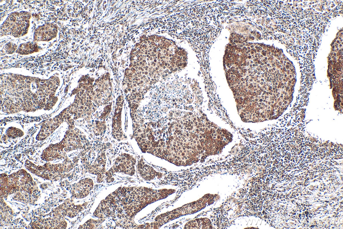 Immunohistochemistry (IHC) staining of human lung cancer tissue using Nucleolin/C23 Polyclonal antibody (10556-1-AP)