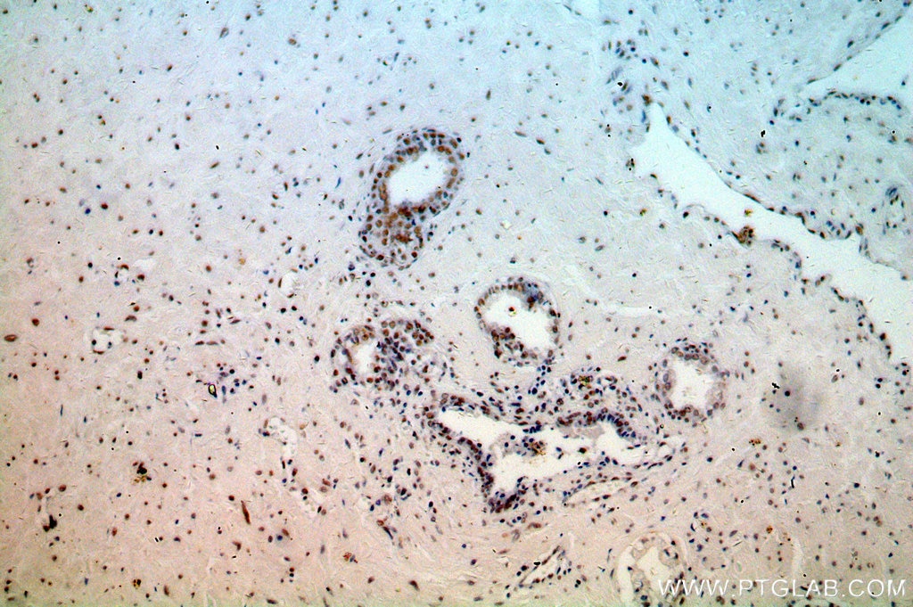 Immunohistochemistry (IHC) staining of human prostate cancer tissue using NCL Polyclonal antibody (10556-1-AP)