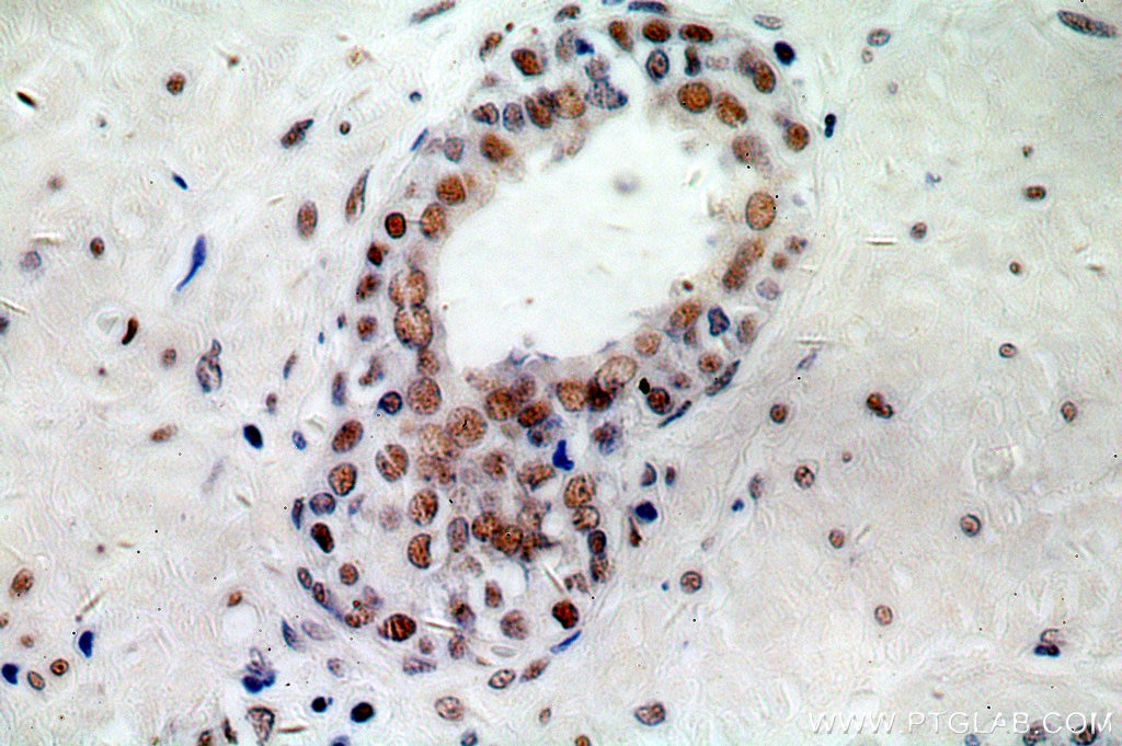 Immunohistochemistry (IHC) staining of human prostate cancer tissue using NCL Polyclonal antibody (10556-1-AP)
