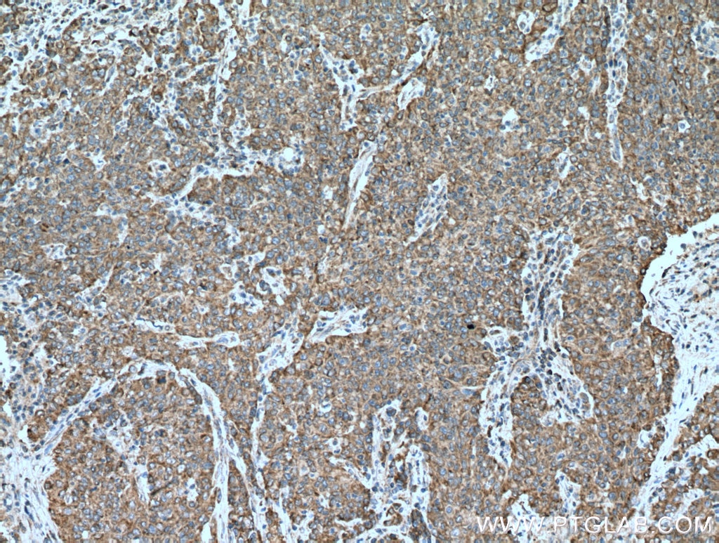 Immunohistochemistry (IHC) staining of human stomach cancer tissue using NCLN Polyclonal antibody (10985-1-AP)