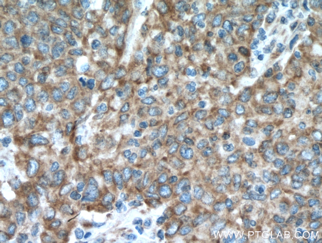 Immunohistochemistry (IHC) staining of human stomach cancer tissue using NCLN Polyclonal antibody (10985-1-AP)