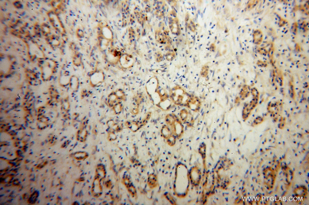 Immunohistochemistry (IHC) staining of human pancreas cancer tissue using NCLN Polyclonal antibody (10985-1-AP)