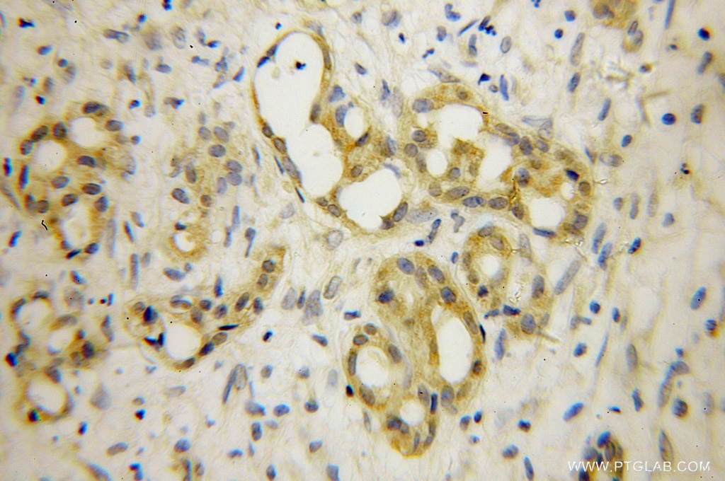 IHC staining of human pancreas cancer using 10985-1-AP