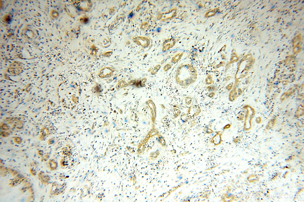 Immunohistochemistry (IHC) staining of human pancreas cancer tissue using NCLN Polyclonal antibody (10985-1-AP)