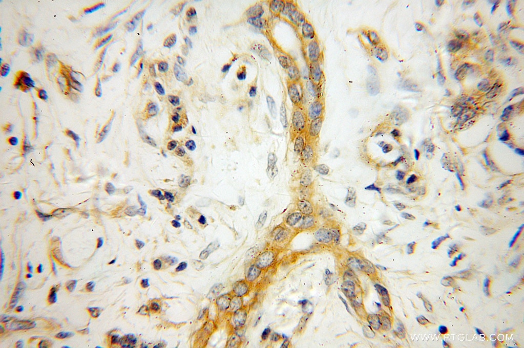 Immunohistochemistry (IHC) staining of human pancreas cancer tissue using NCLN Polyclonal antibody (10985-1-AP)