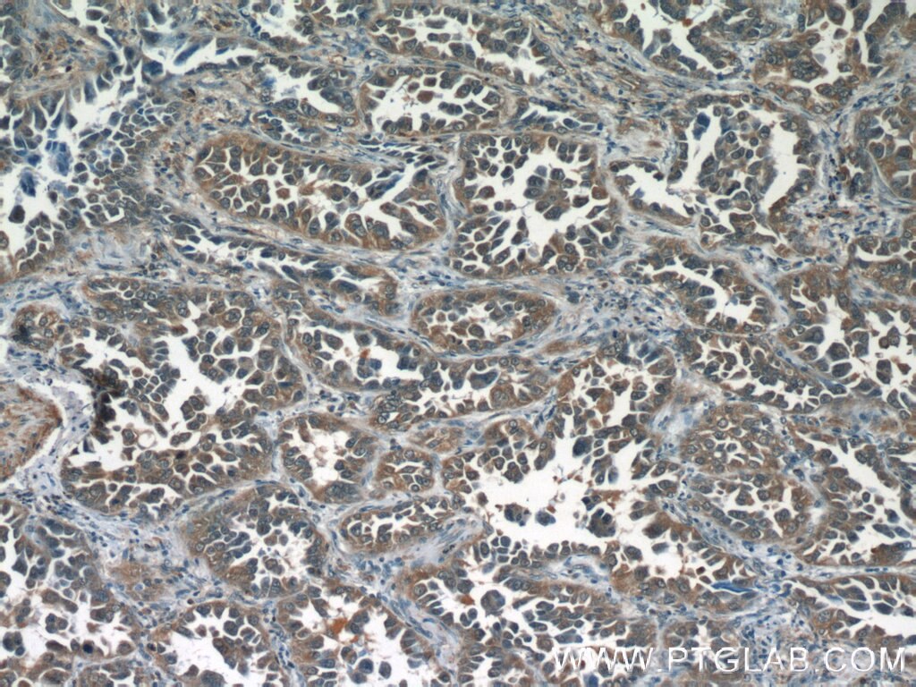 Immunohistochemistry (IHC) staining of human lung cancer tissue using SRC3/NCOA3 Polyclonal antibody (20032-1-AP)