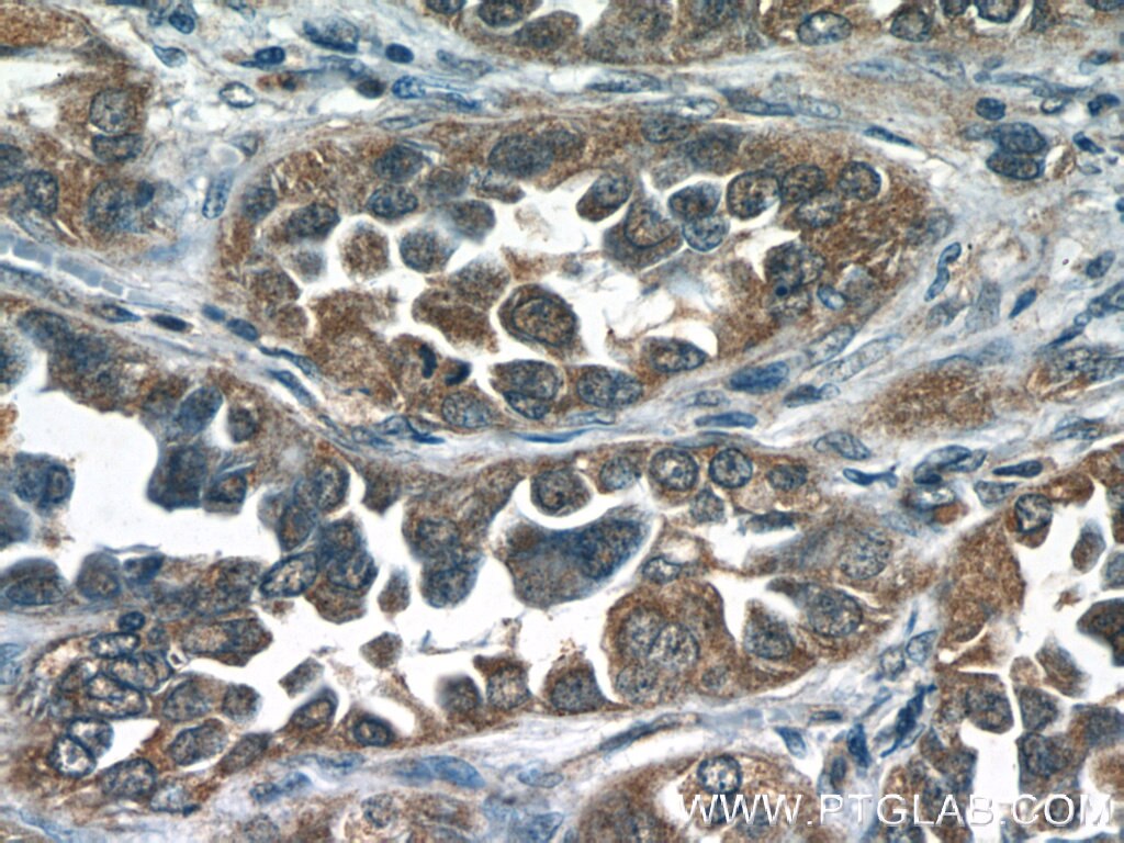 Immunohistochemistry (IHC) staining of human lung cancer tissue using SRC3/NCOA3 Polyclonal antibody (20032-1-AP)