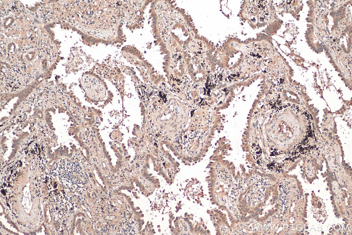 Immunohistochemistry (IHC) staining of human lung cancer tissue using NCOA3 Polyclonal antibody (29587-1-AP)