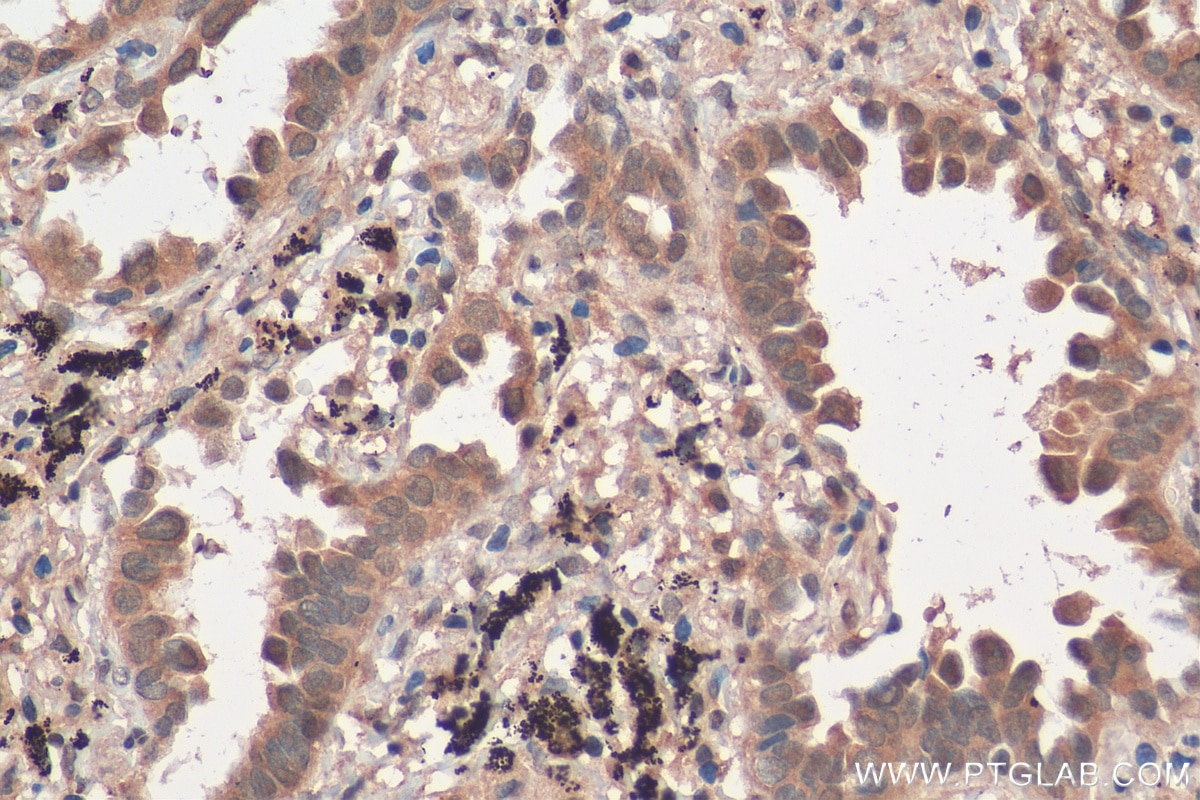 Immunohistochemistry (IHC) staining of human lung cancer tissue using NCOA3 Polyclonal antibody (29587-1-AP)