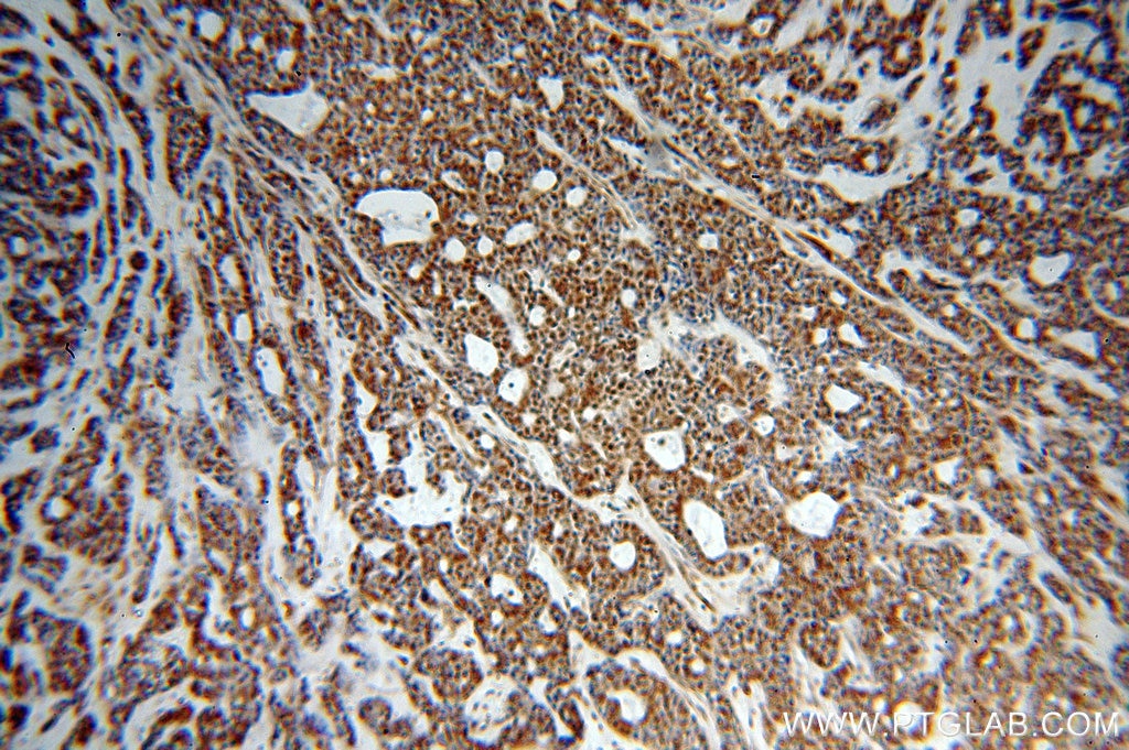 Immunohistochemistry (IHC) staining of human cervical cancer tissue using NCOR1 Polyclonal antibody (20018-1-AP)