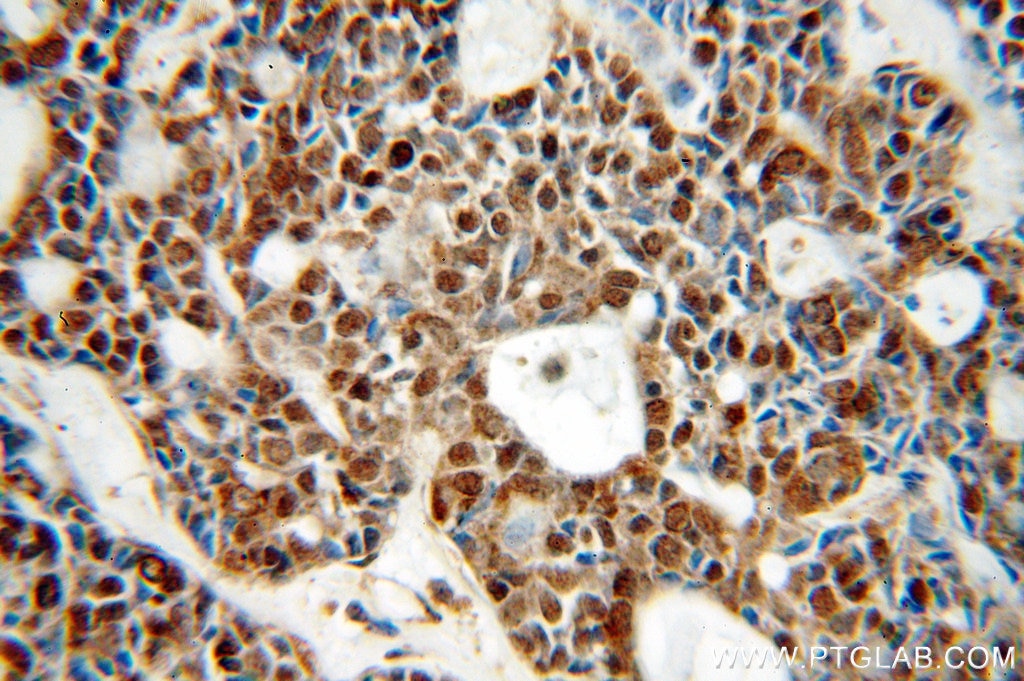 Immunohistochemistry (IHC) staining of human cervical cancer tissue using NCOR1 Polyclonal antibody (20018-1-AP)