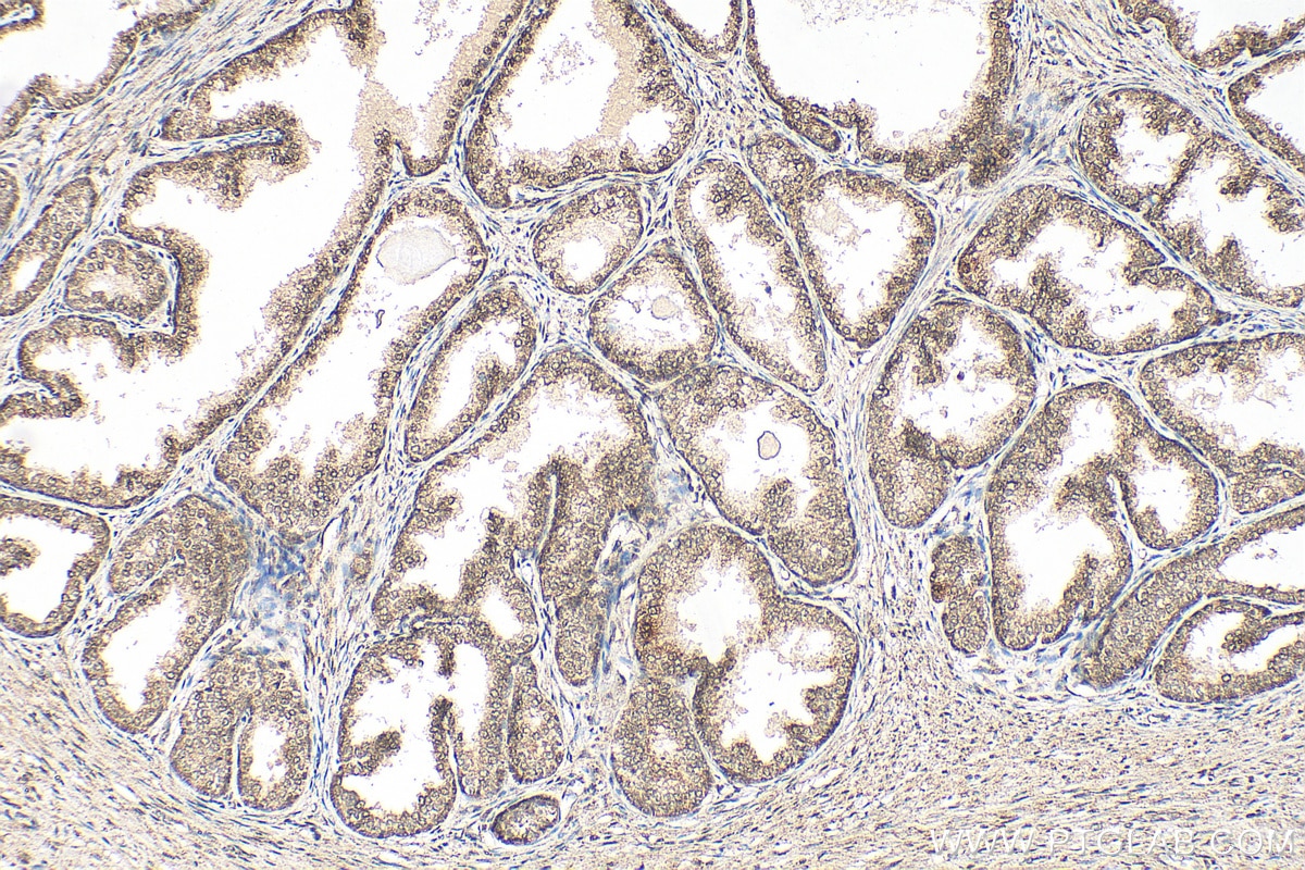 IHC staining of human prostate cancer using 29952-1-AP