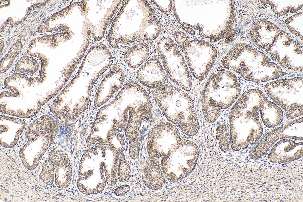 Immunohistochemistry (IHC) staining of human prostate cancer tissue using NCOR2 Polyclonal antibody (29952-1-AP)