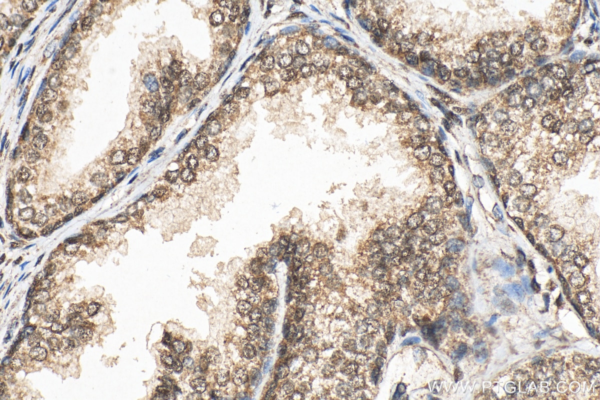 Immunohistochemistry (IHC) staining of human prostate cancer tissue using NCOR2 Polyclonal antibody (29952-1-AP)