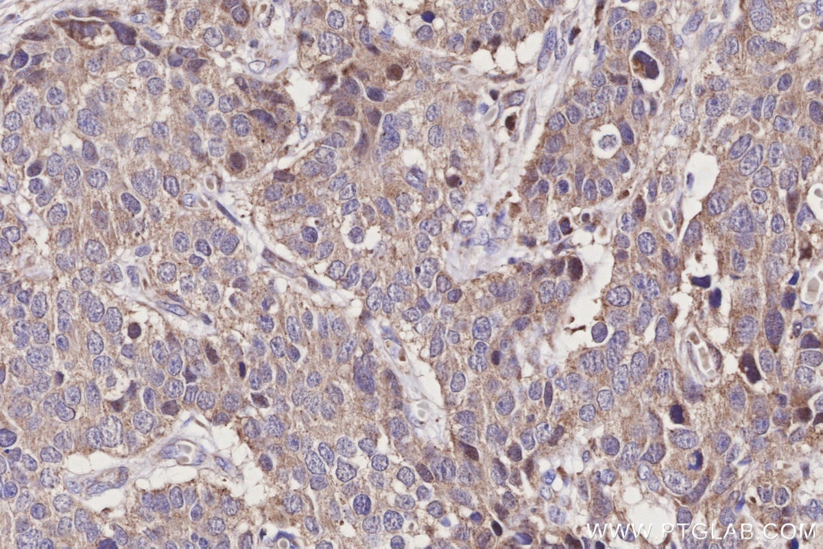 IHC staining of human stomach cancer using 19703-1-AP Immunohistochemistry (IHC) staining of human stomach cancer tissue using ND1 Polyclonal antibody (19703-1-AP)