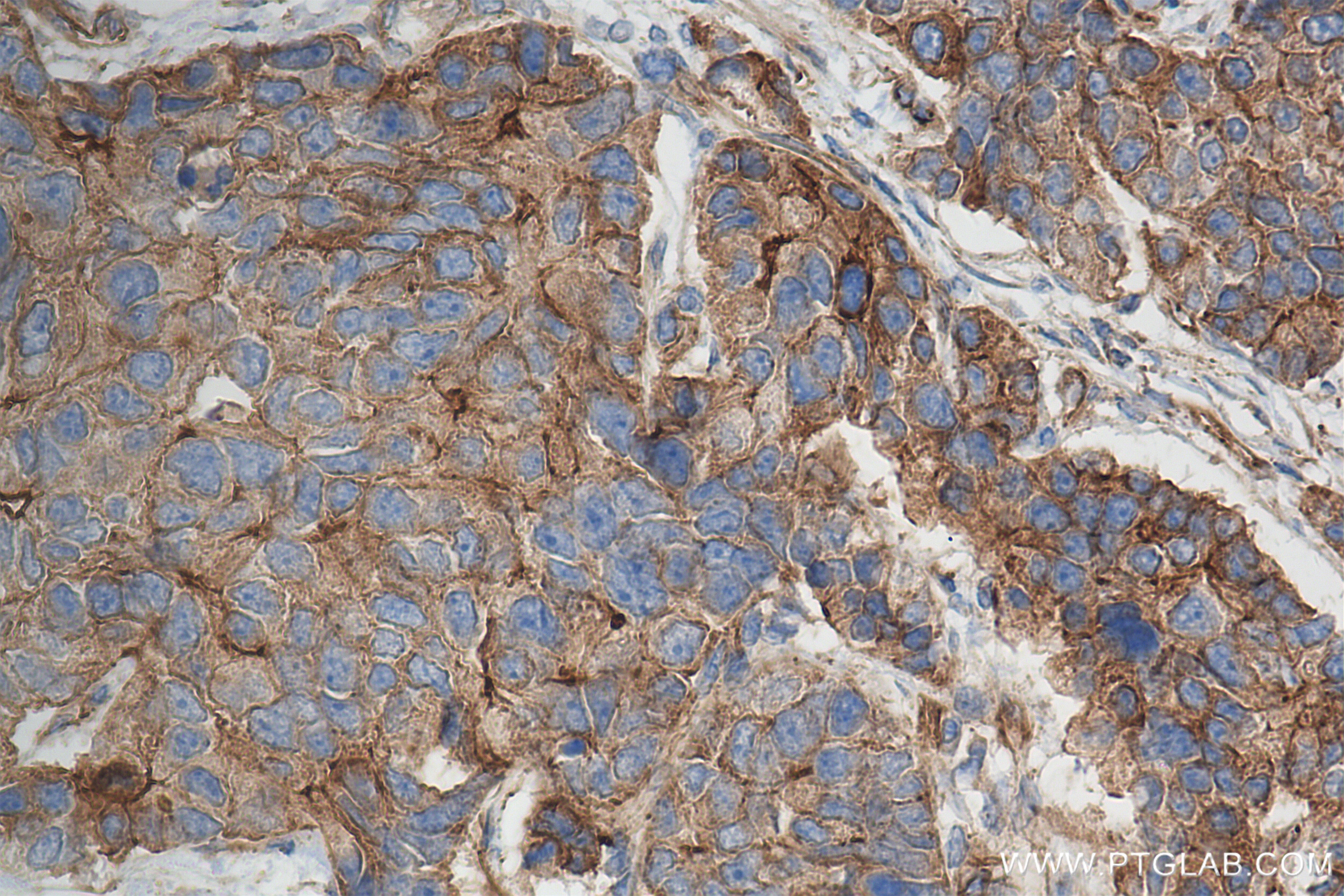 Immunohistochemistry (IHC) staining of human stomach cancer tissue using ND4 Recombinant antibody (85098-1-RR)