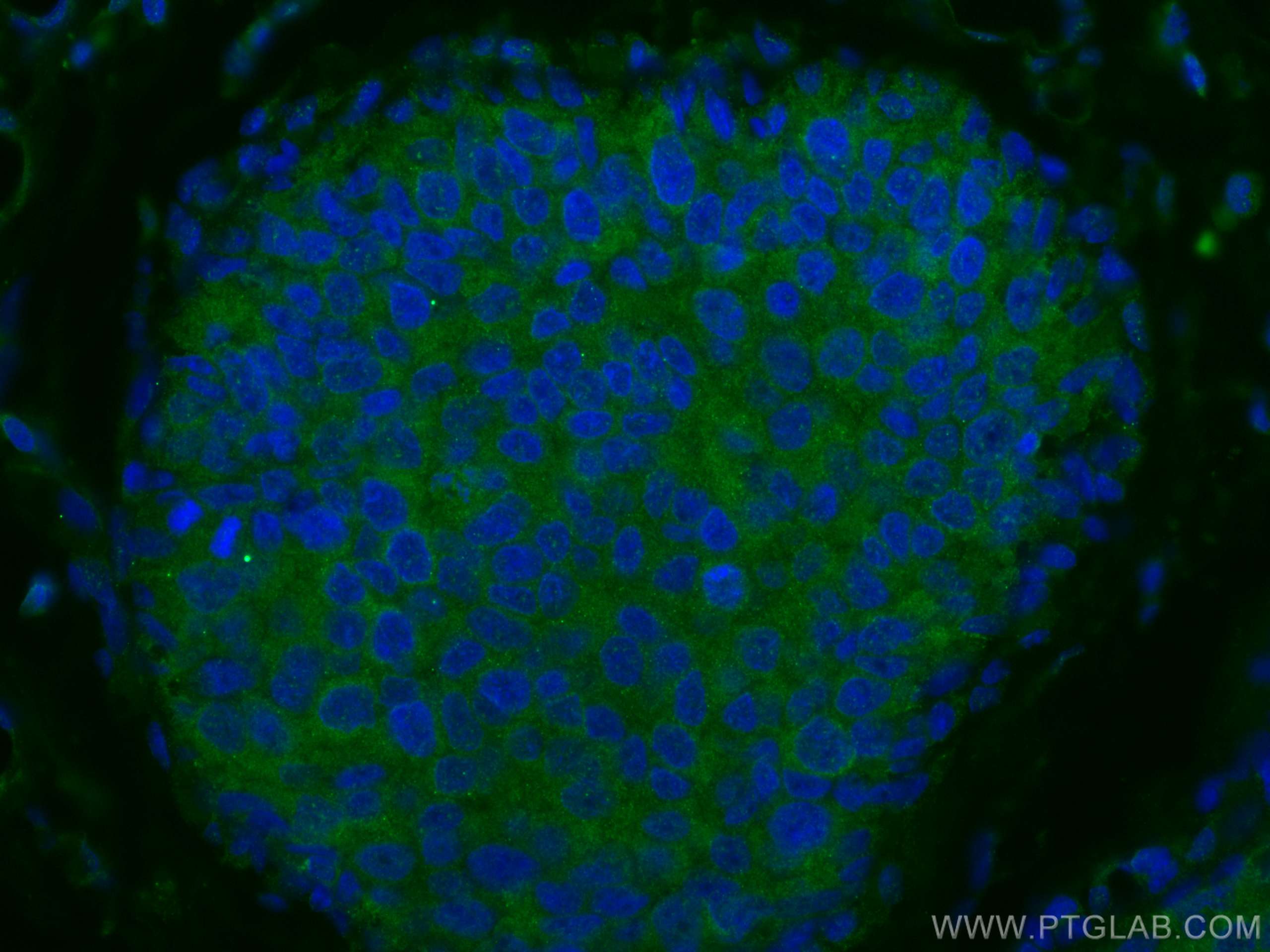 Immunofluorescence (IF) / fluorescent staining of human breast cancer tissue using NDE1 Polyclonal antibody (10233-1-AP)