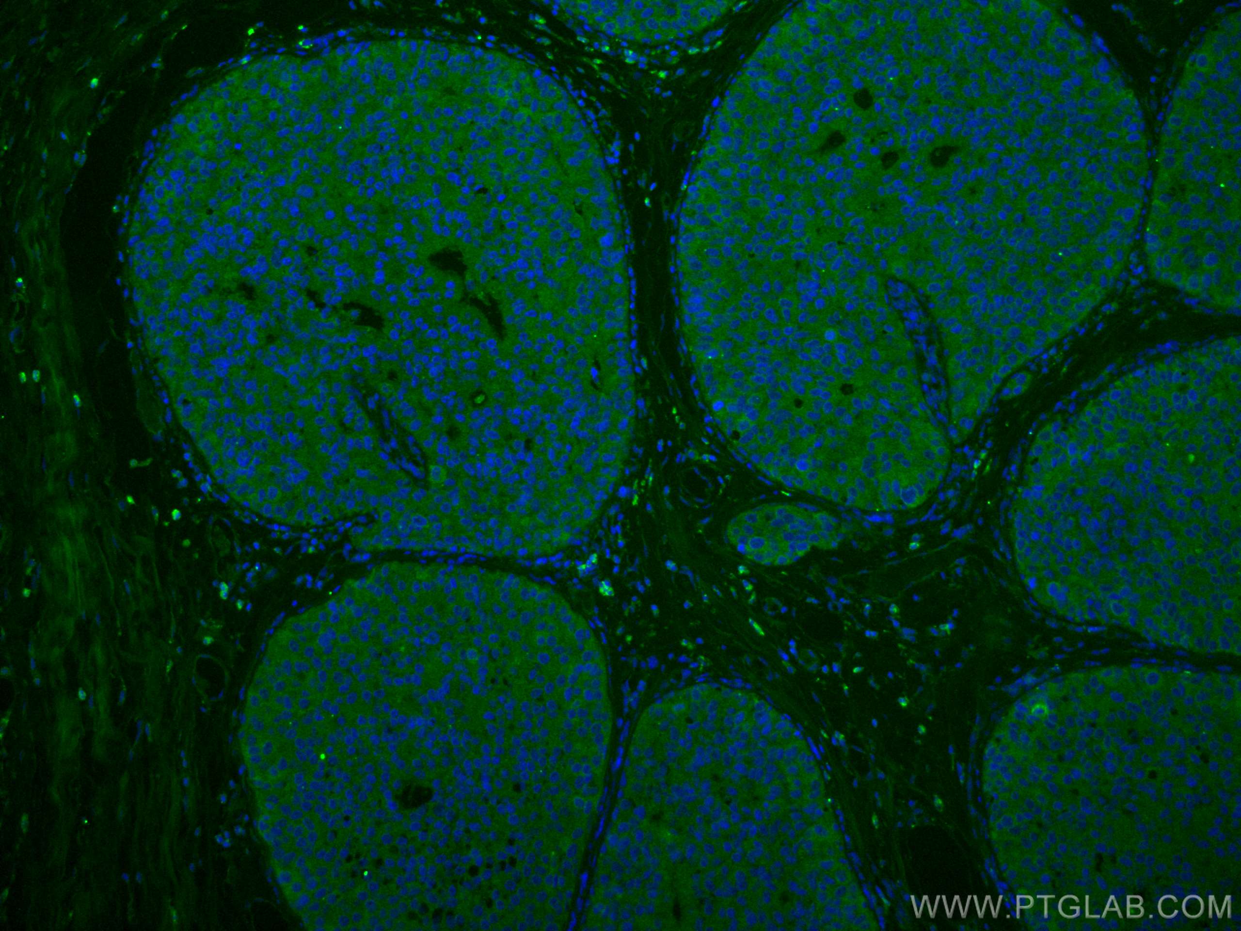 IF Staining of human breast cancer using 10233-1-AP