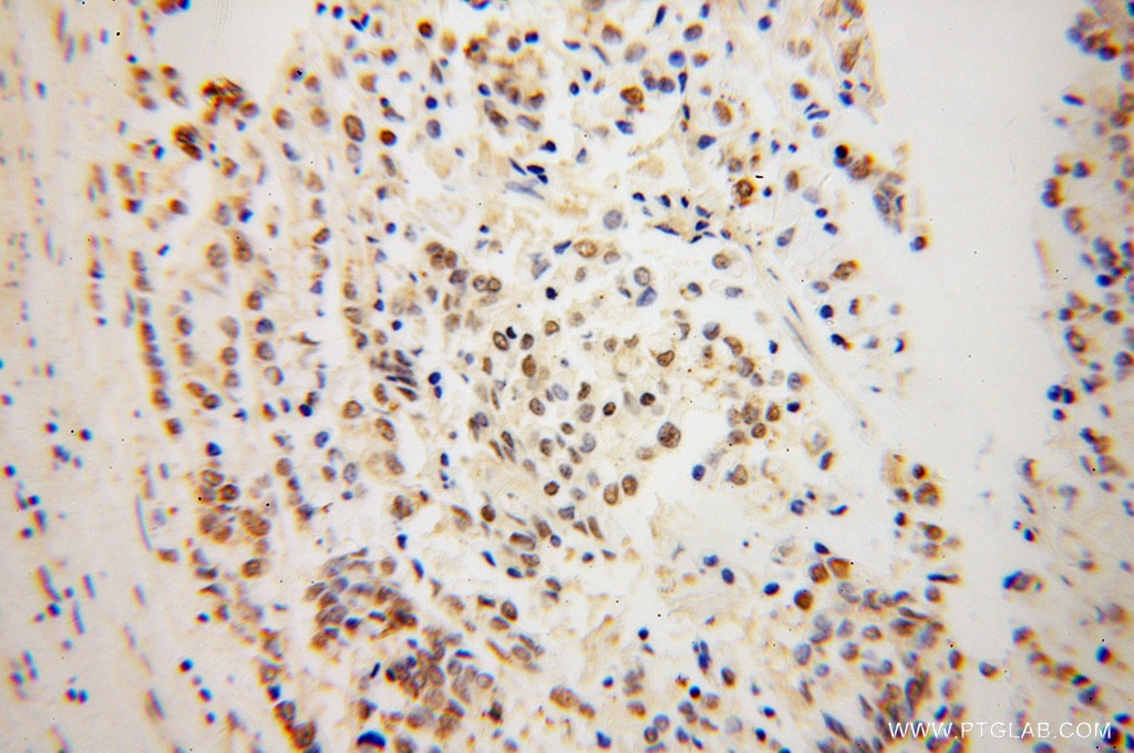 IHC staining of human colon cancer using 10233-1-AP