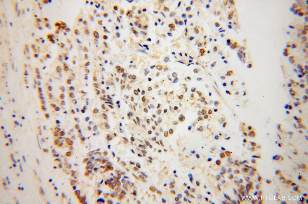 Immunohistochemistry (IHC) staining of human colon cancer tissue using NDE1 Polyclonal antibody (10233-1-AP)