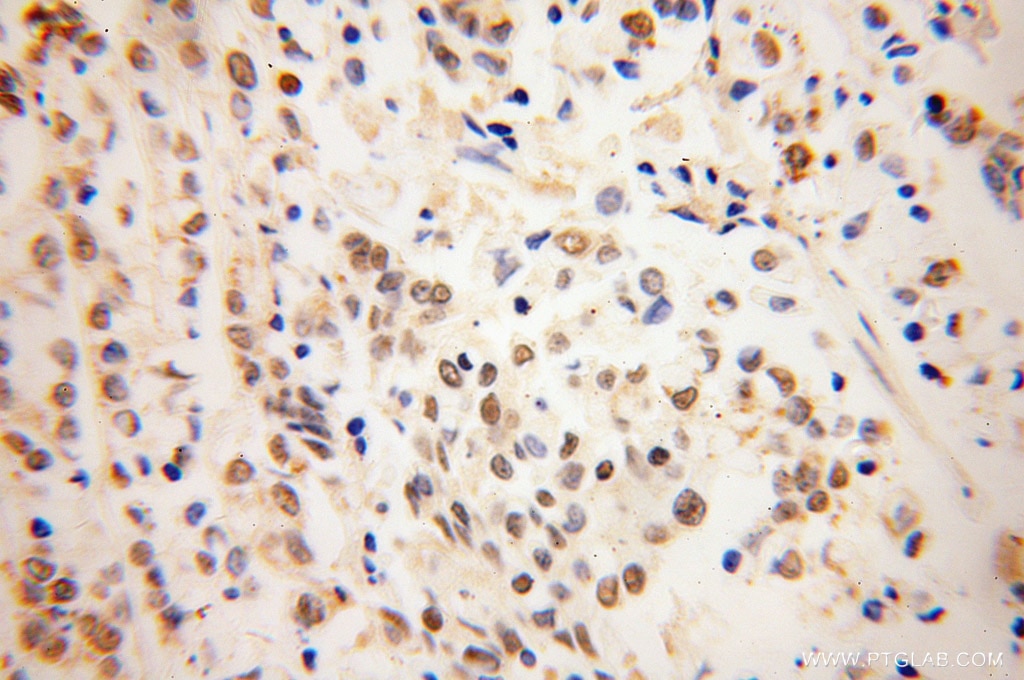 Immunohistochemistry (IHC) staining of human colon cancer tissue using NDE1 Polyclonal antibody (10233-1-AP)