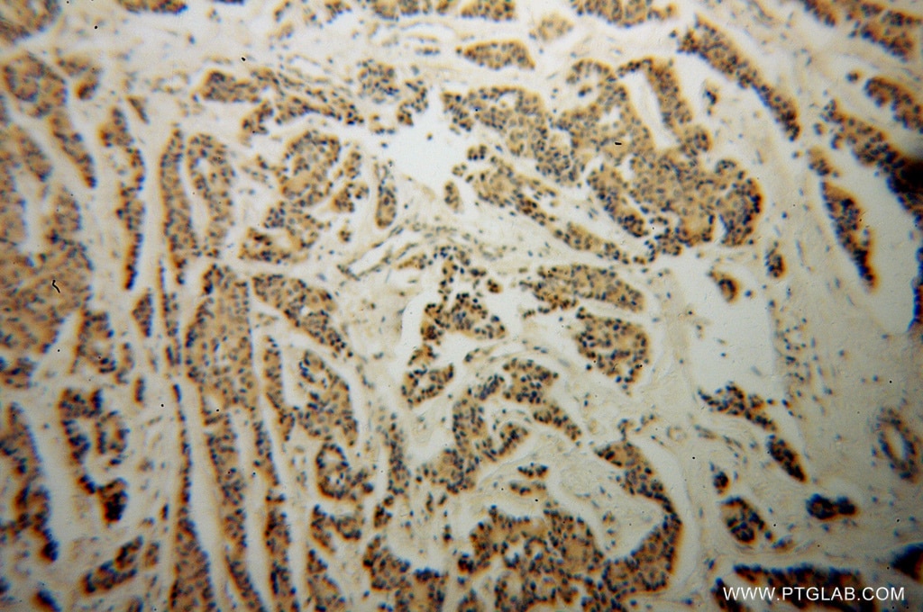 IHC staining of human breast cancer using 10233-1-AP