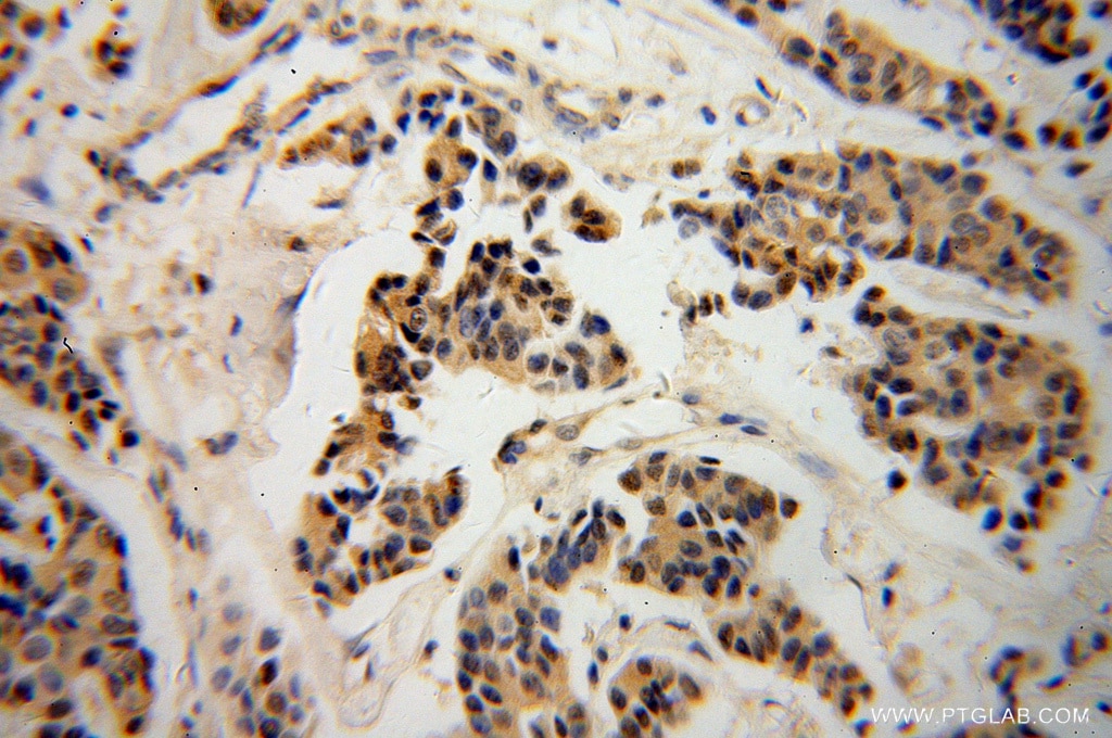 Immunohistochemistry (IHC) staining of human breast cancer tissue using NDE1 Polyclonal antibody (10233-1-AP)