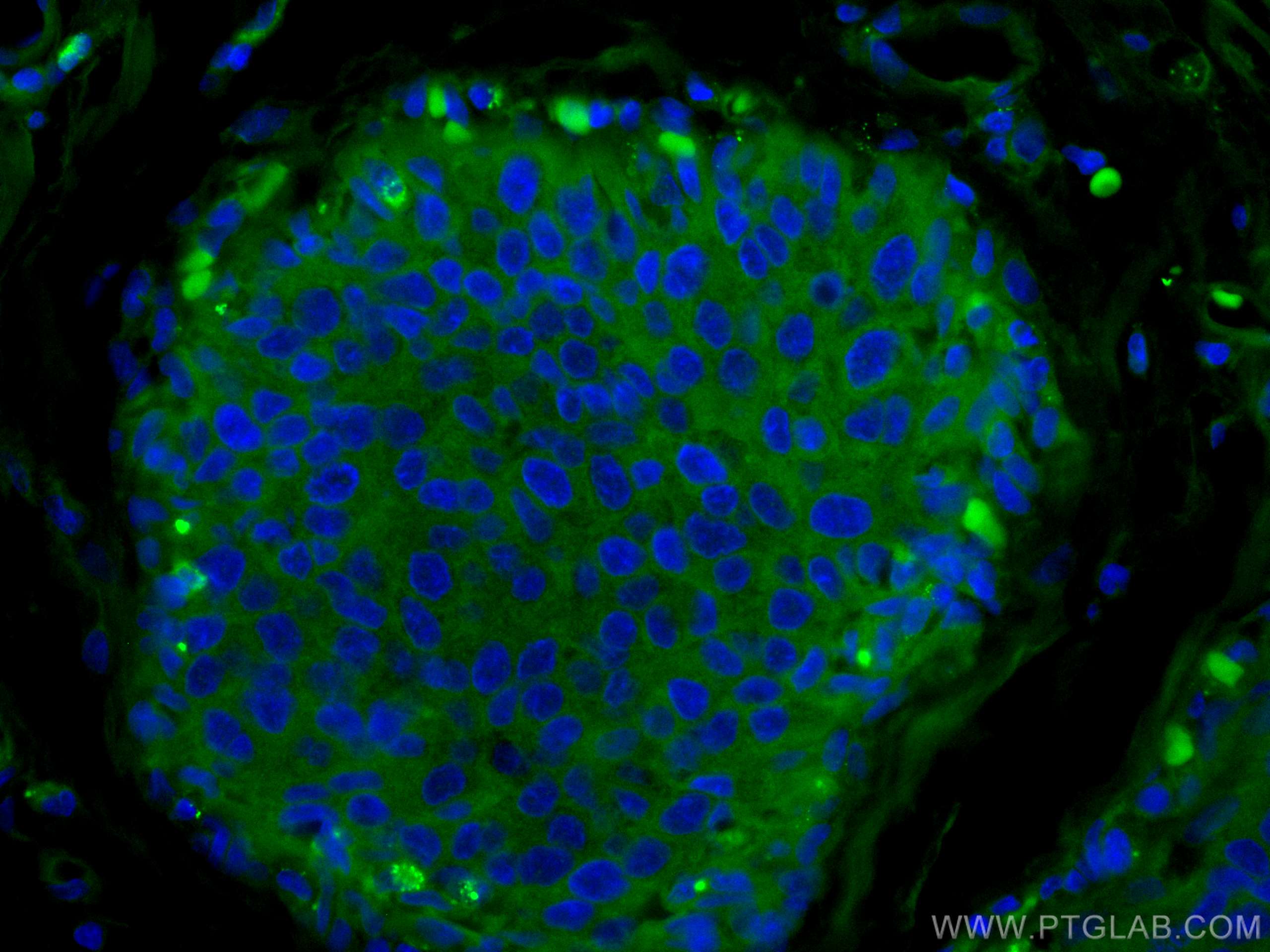 Immunofluorescence (IF) / fluorescent staining of human breast cancer tissue using CoraLite® Plus 488-conjugated NDE1 Polyclonal anti (CL488-10233)