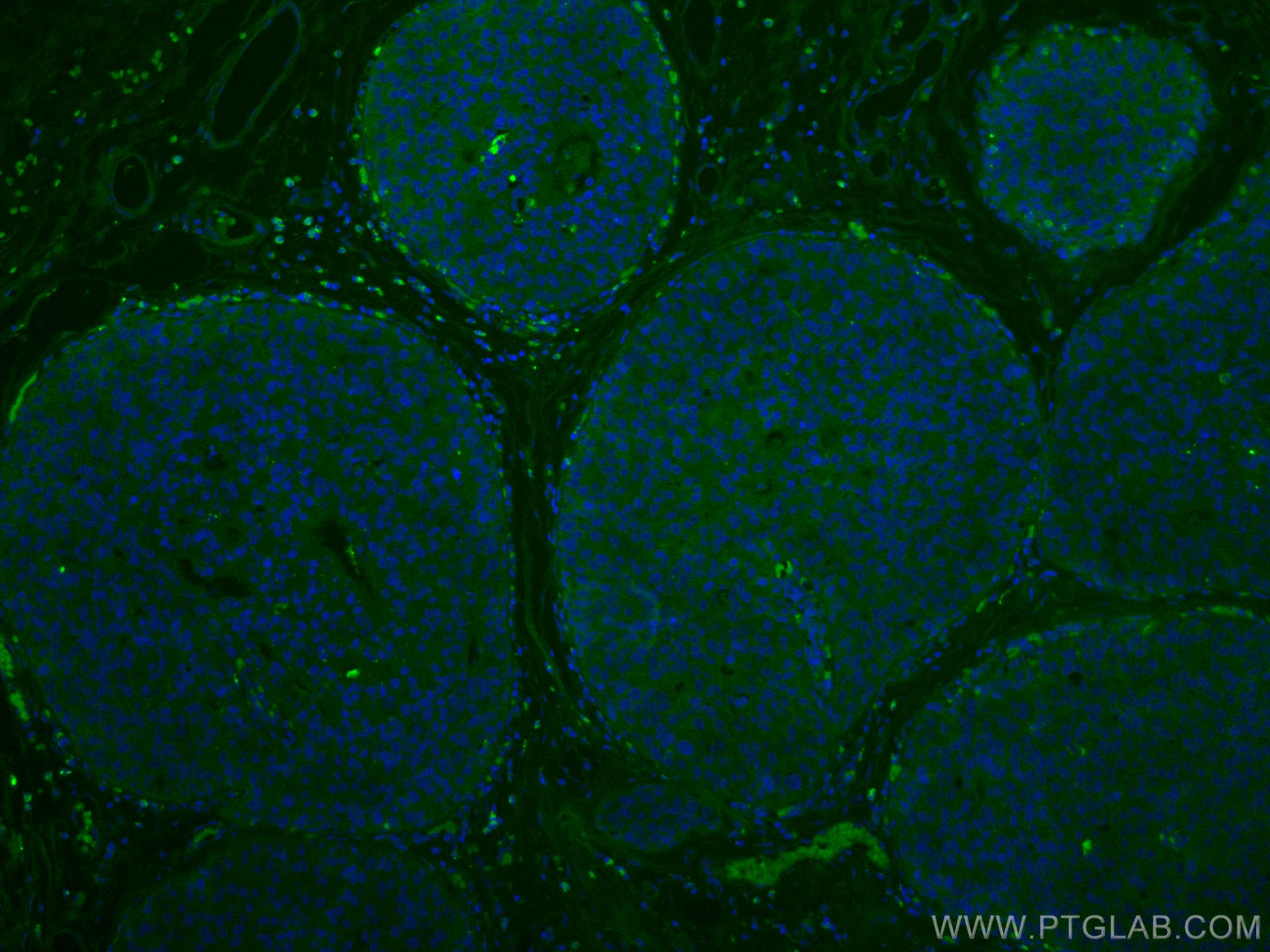 Immunofluorescence (IF) / fluorescent staining of human breast cancer tissue using CoraLite® Plus 488-conjugated NDE1 Polyclonal anti (CL488-10233)