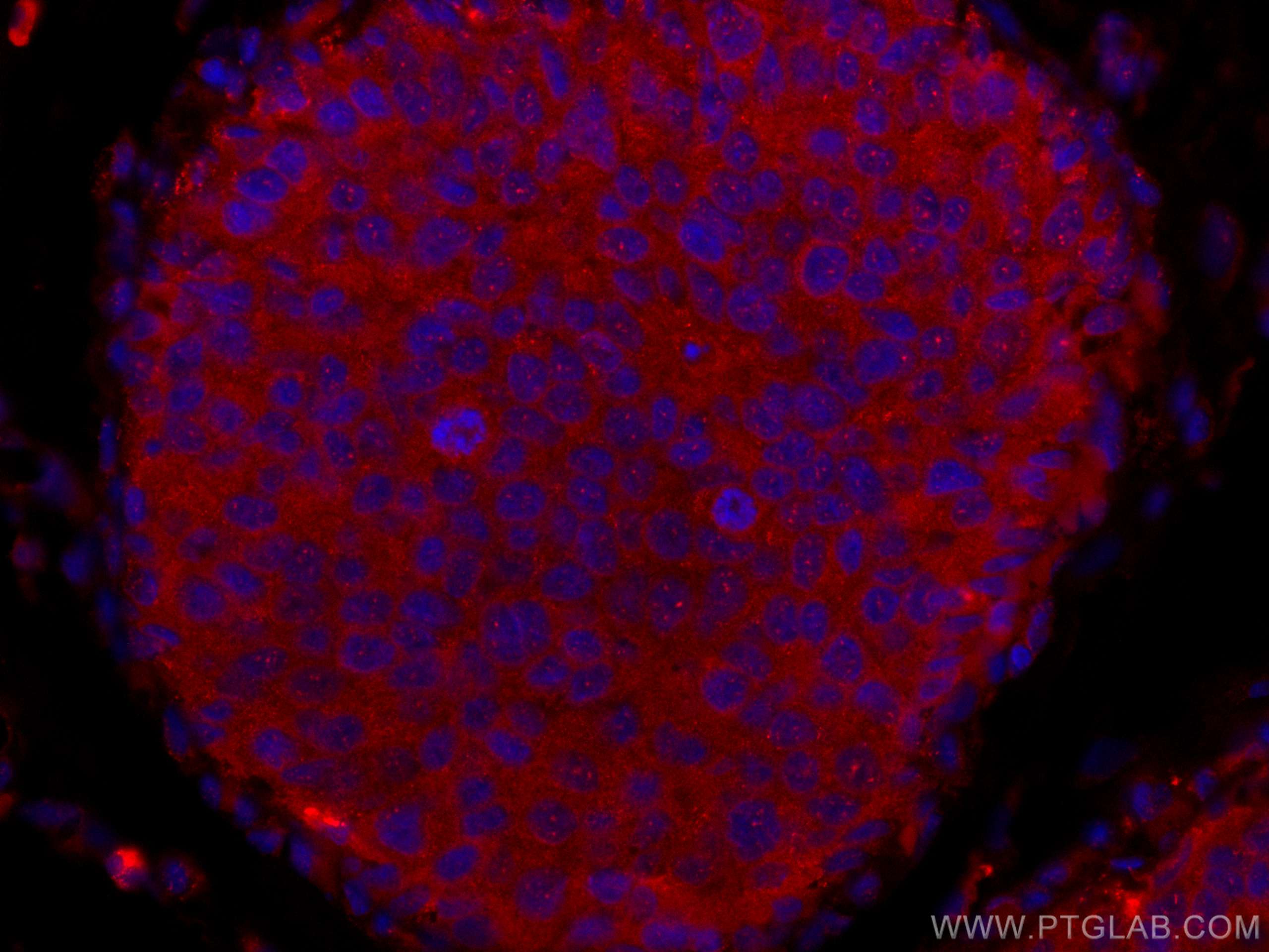 Immunofluorescence (IF) / fluorescent staining of human breast cancer tissue using CoraLite®594-conjugated NDE1 Polyclonal antibody (CL594-10233)