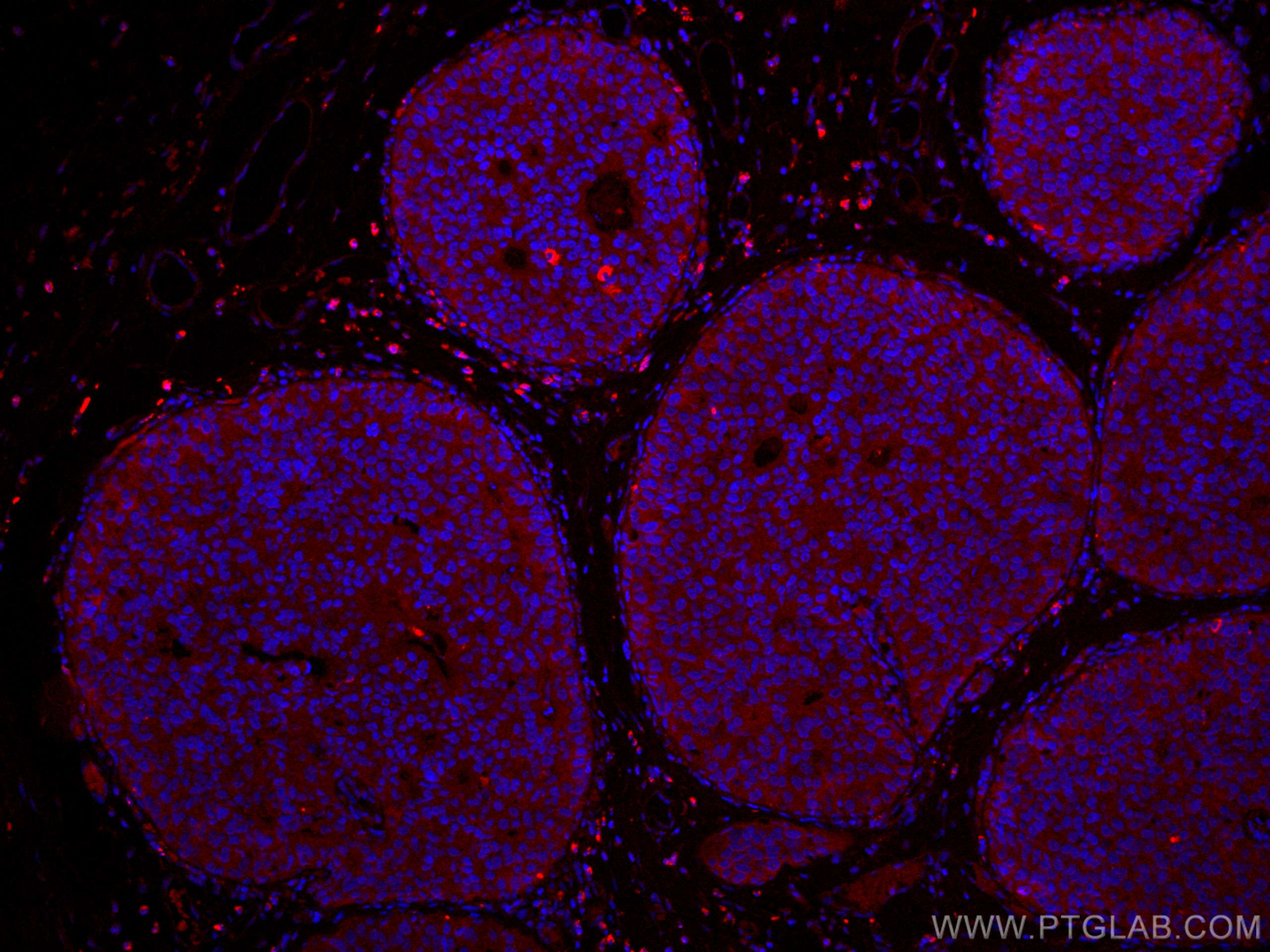 Immunofluorescence (IF) / fluorescent staining of human breast cancer tissue using CoraLite®594-conjugated NDE1 Polyclonal antibody (CL594-10233)