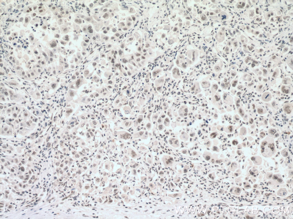 Immunohistochemistry (IHC) staining of human liver cancer tissue using NDNL2 Polyclonal antibody (27488-1-AP)