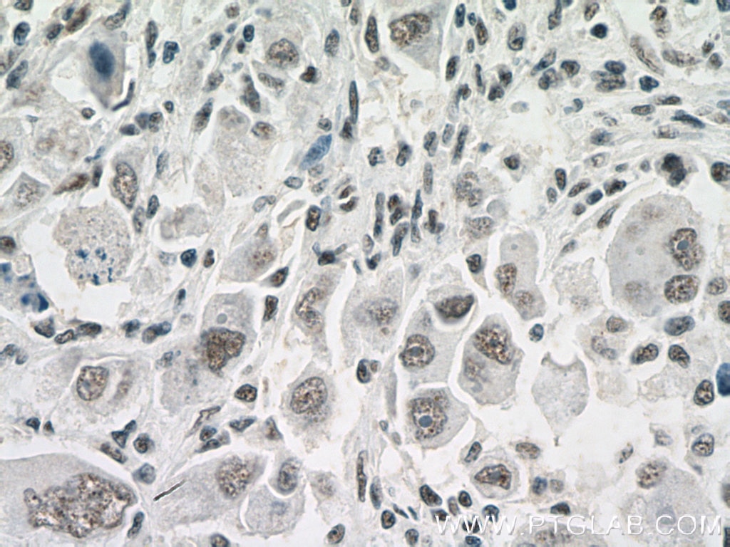 IHC staining of human liver cancer using 27488-1-AP