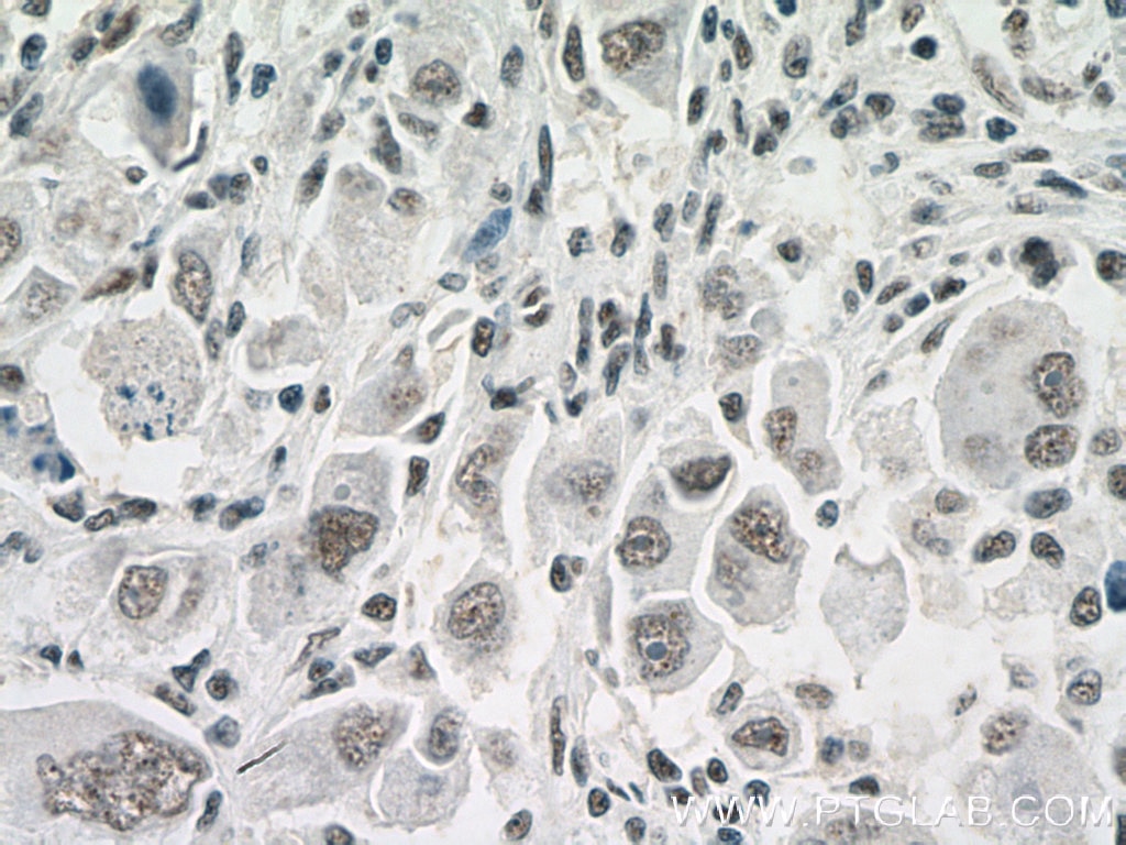 Immunohistochemistry (IHC) staining of human liver cancer tissue using NDNL2 Polyclonal antibody (27488-1-AP)