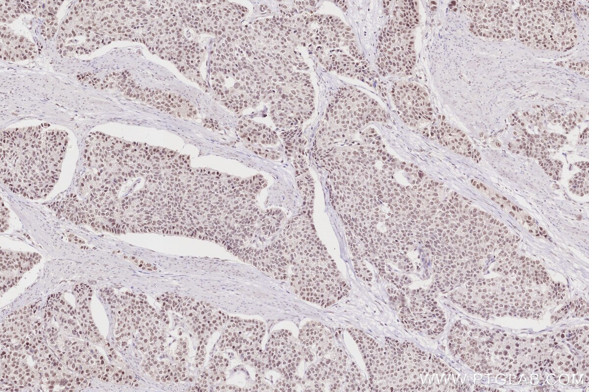 Immunohistochemistry (IHC) staining of human stomach cancer tissue using NDNL2 Polyclonal antibody (27488-1-AP)