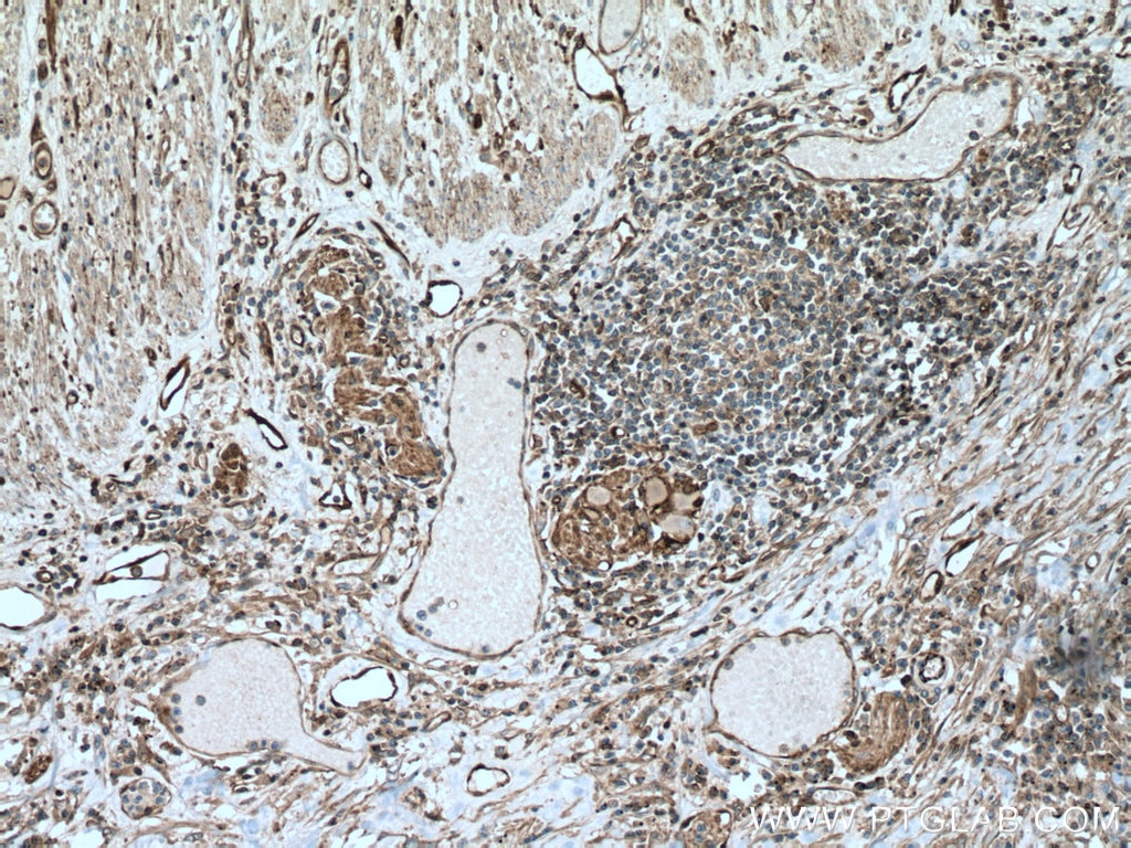 Immunohistochemistry (IHC) staining of human colon cancer tissue using NDRG1 Polyclonal antibody (26902-1-AP)