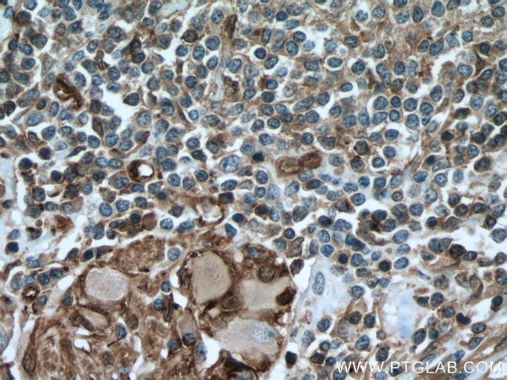 Immunohistochemistry (IHC) staining of human colon cancer tissue using NDRG1 Polyclonal antibody (26902-1-AP)