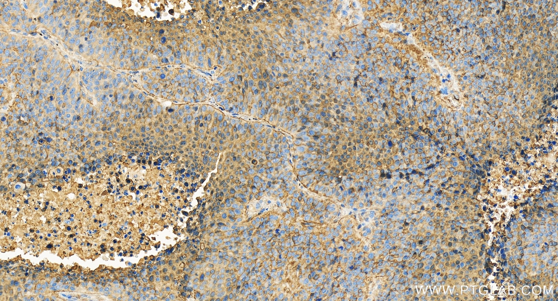 Immunohistochemistry (IHC) staining of human lung cancer tissue using NDRG1 Recombinant antibody (85141-4-RR)